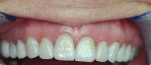 before and after Preventative Dentistry