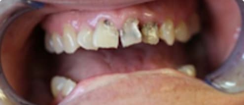 before and after xxxxx 0001s 0000 crowns filling 1 copy Snap on Dentures