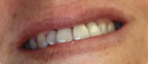 before and after xxxxx 0001s 0001 crowns filling 1 Veneers