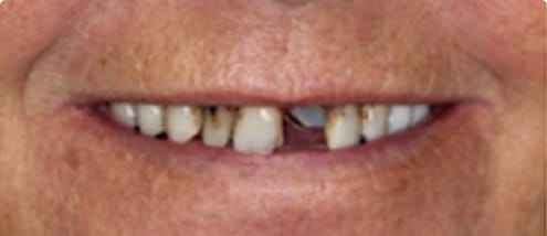 before and after xxxxx 0002s 0001 12 1 Denture Partials