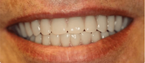 before and after xxxxx 0003s 0000 34 copy Teeth Whitening