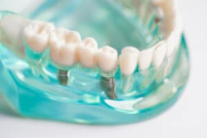 dental implant artificial tooth roots into jaw root canal dental treatment gum disease teeth model dentist studying about dentistry Blog