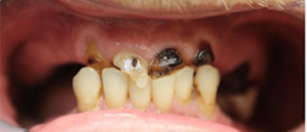 dental implant before Dental Implant