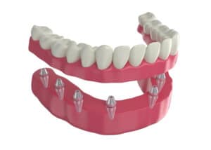 dental prosthesis 8 overdenture implants lower arch 3d render Blog