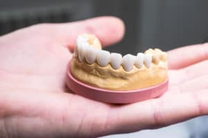 jaw with ceramic teeth dentist39s device hand closeup Blog