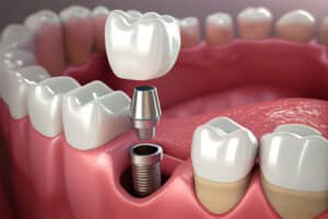 removable partial denture medically accurate toothgenerative ai Blog